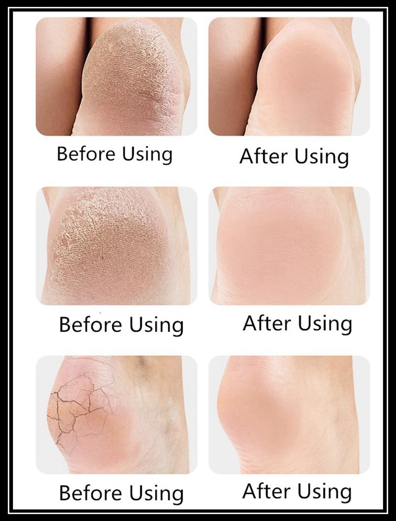 Anti-Crack Heal Set - Pair